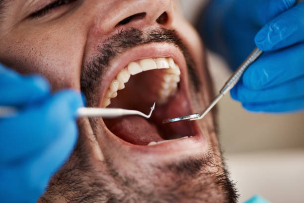 Best Dentist for Tooth Abscess  in Milton, DE